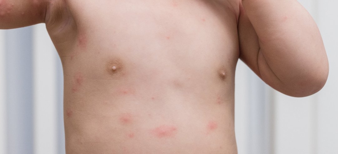 Newborn Rashes