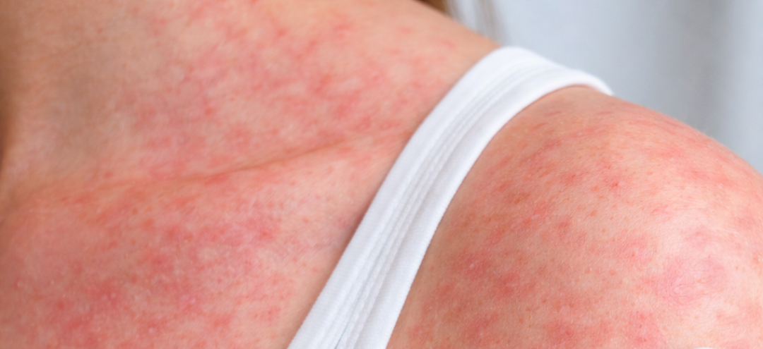 Rashes Rashes